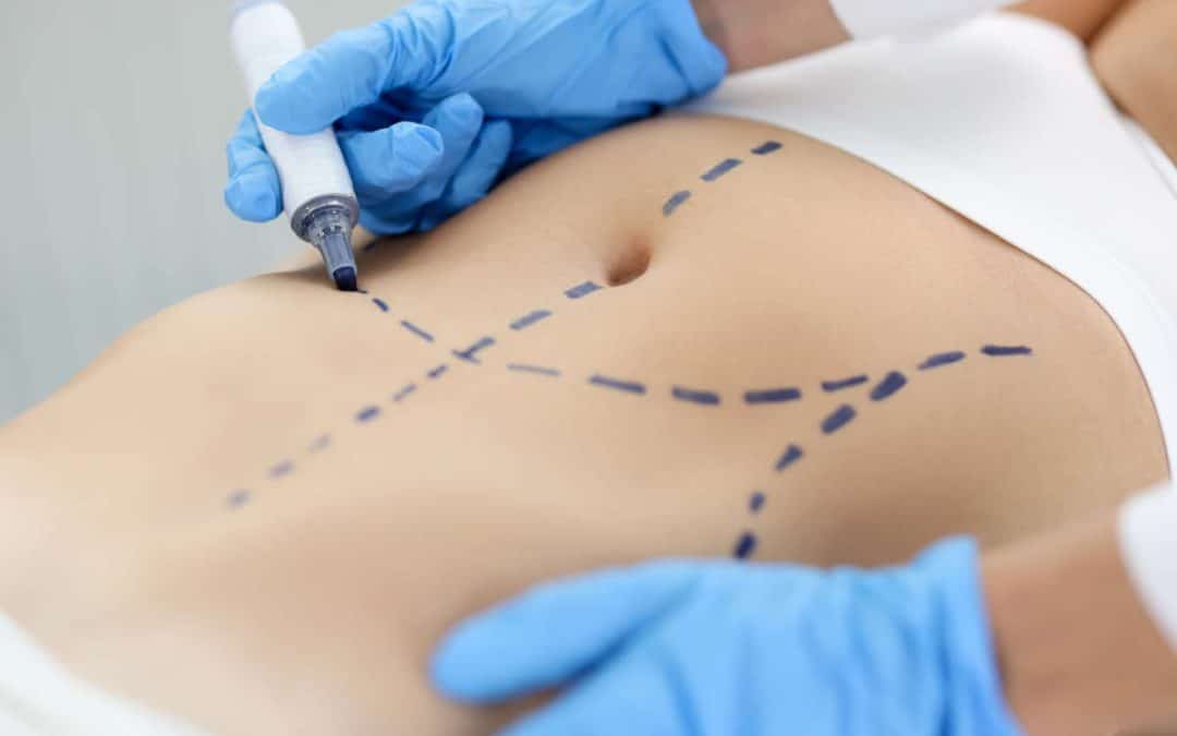 Risques et complications spécifiques de l&rsquo;abdominoplastie : ce qu&rsquo;il faut savoir